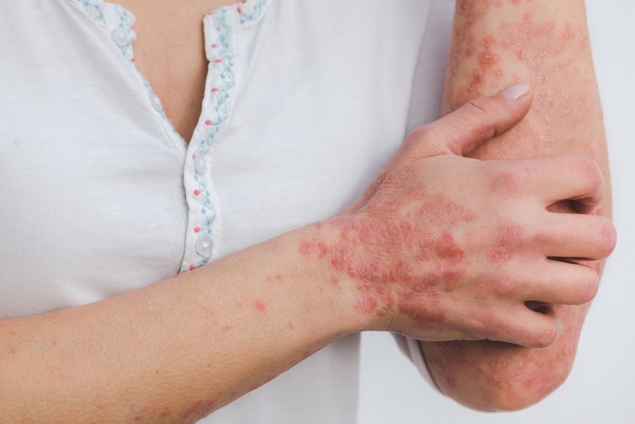 PSORIASIS: SYMPTOMS, TYPES AND TREATMENT