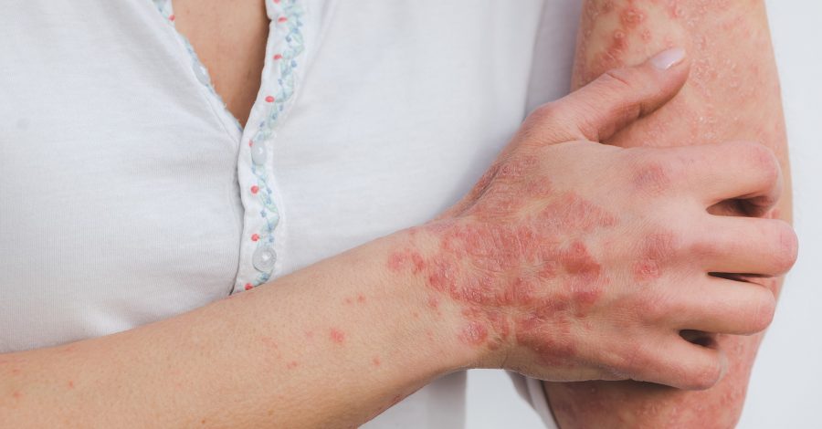 PSORIASIS: SYMPTOMS, TYPES AND TREATMENT